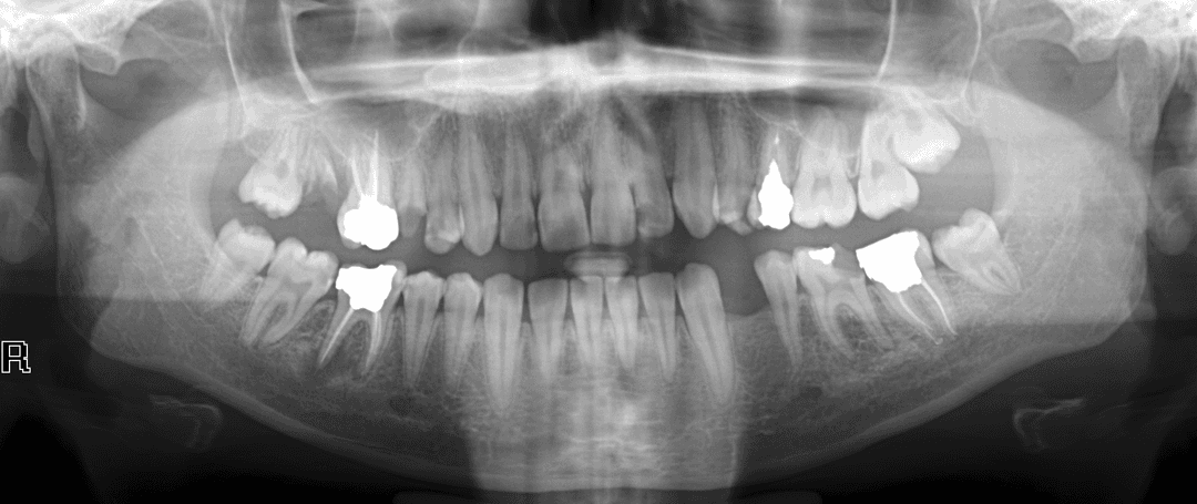 Image Segmentation Original X-ray