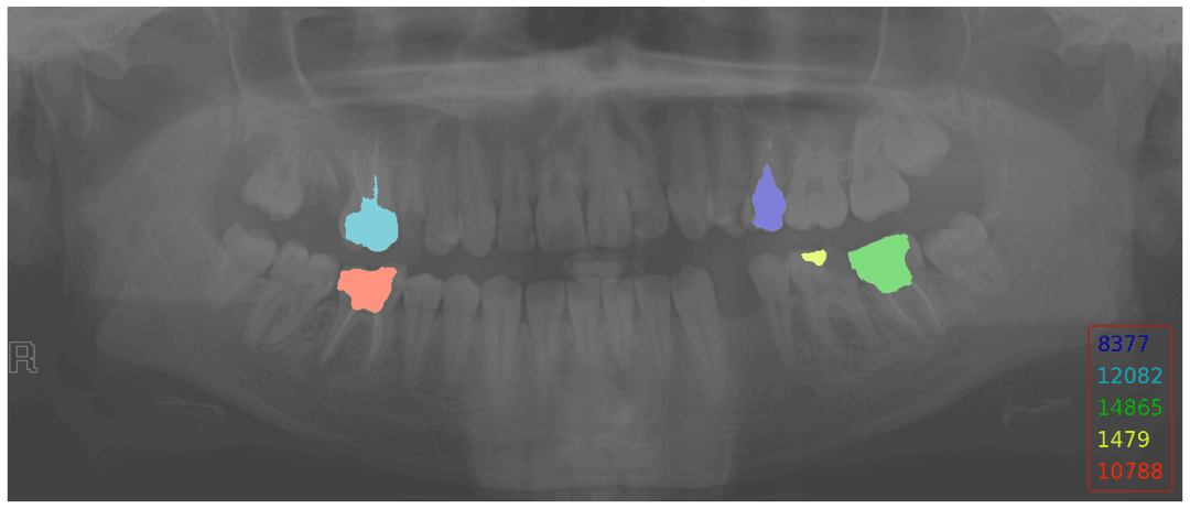 Image Segmentation Segmented X-ray